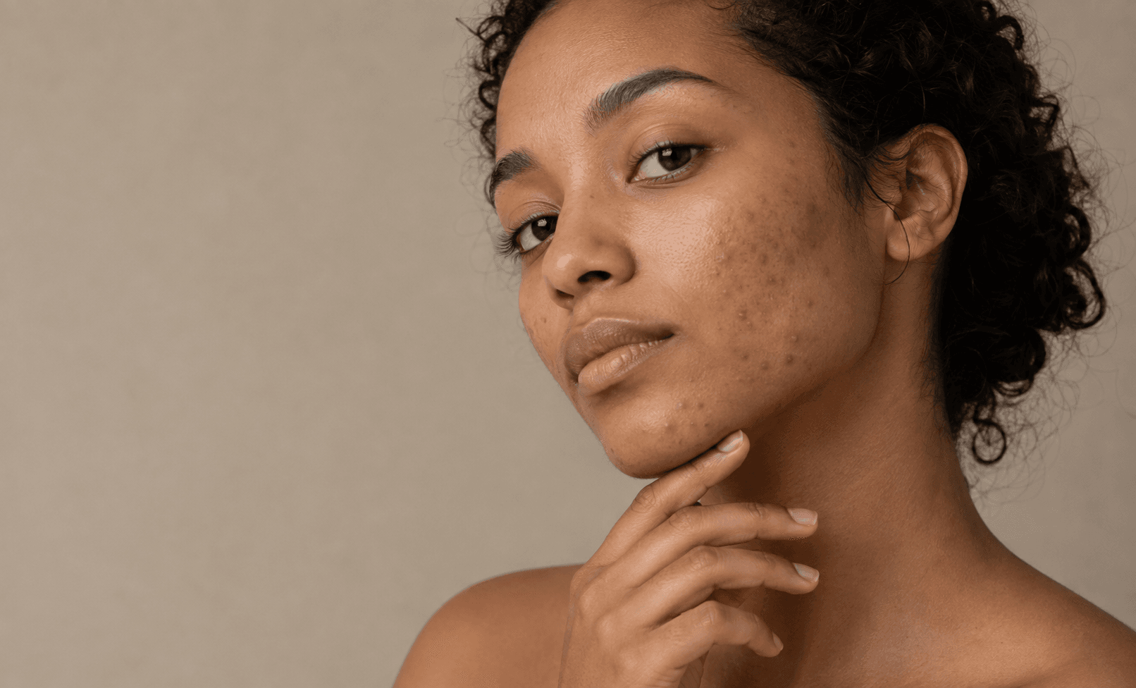 acne blog.png